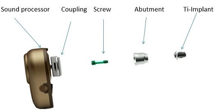 Ponto bone anchored hearing system