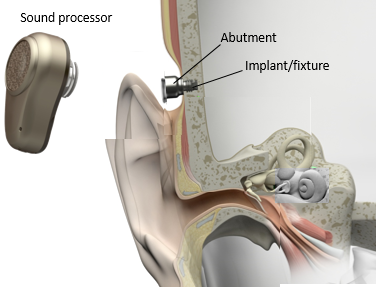 Direct bone conduction, from the sound processor, across the abutment, and directly into the bone of the skull