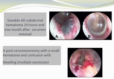 Subdermal hematomas following cerumen removal