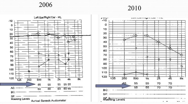 Case of under masking, which is a clinical error