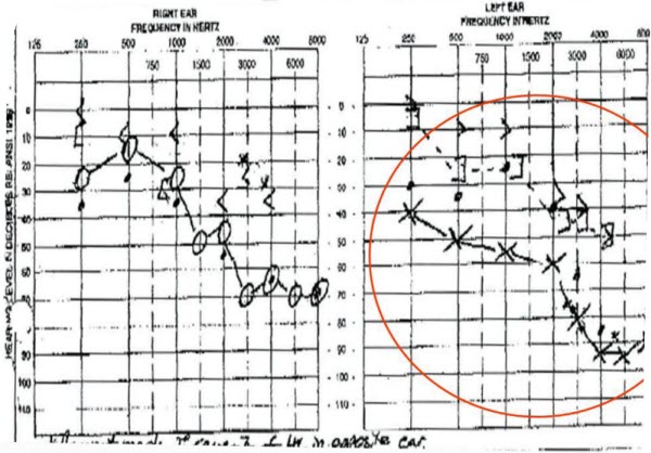Audiogram from the same 68-year-old patient after left-ear impression, now showing mixed hearing loss