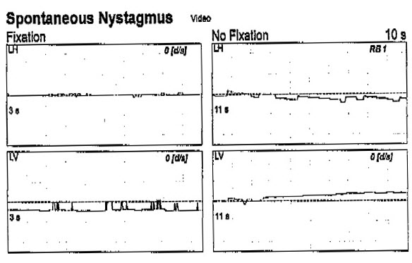 Case example of a 69-year-old VNG result, recorded by an extern clinician
