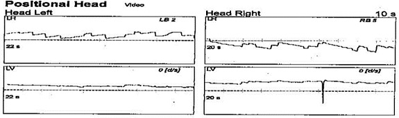 Positional data from head-left and head-right conditions that yielded bilateral nystagmus