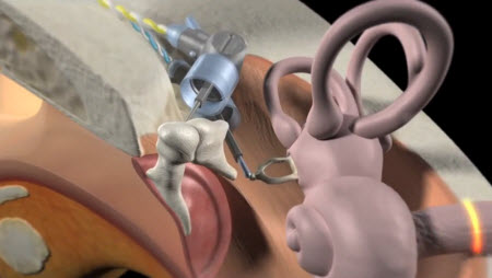 How the Esteem Hearing Implant Works