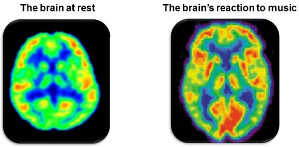 PET scan of brain at rest and while listening to music 