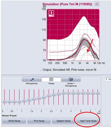 TAT settings in a Simens micon hearing aid for a patient with no hearing loss