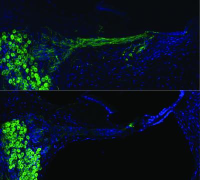  regenerated auditory nerves after gene therapy compared with no treatment