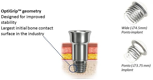 OptiGrip implant and comparison of wide and standard Ponto implants