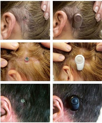 Examples of tissue preservation outcomes after surgery and processor loading