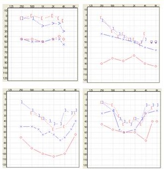 Conductive and mixed audiometric results of candidates for bone anchored hearing systems