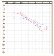 Audiogram of a patient with skin allergies in the ear canal who could not use traditional air conduction hearing aids