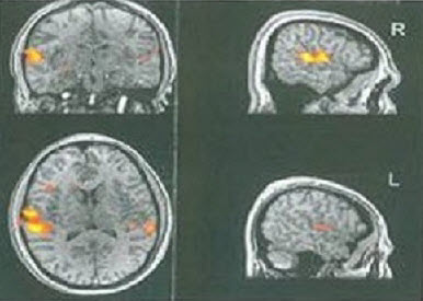 MRI results from an 18-year old male APD patient with a right-ear dichotic deficit