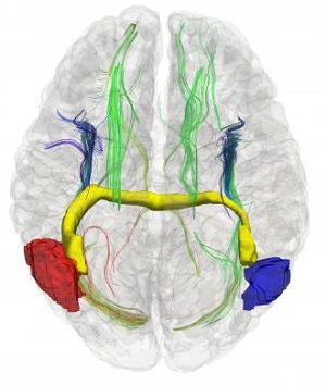 3D image showing some of the aberrant interhemispheric bundles in a "glass brain" of a subject born without the corpus callosum