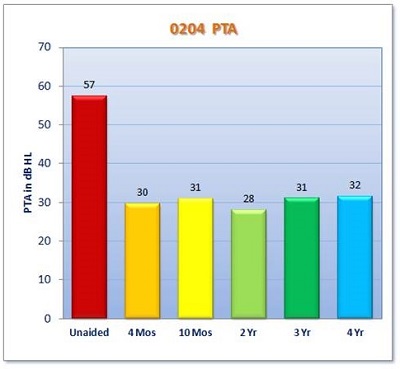 Average PTA across all clinical trial subjects over four years