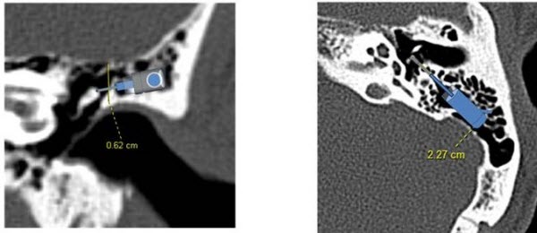 Overlay of Esteem transducer components on a CT scan to show how the parts will be accommodated within the middle ear space