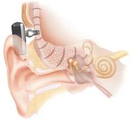 Baha osseointegrated system with internal implant, abutment, and sound processor