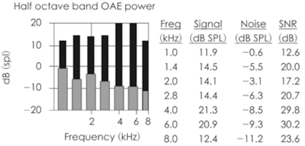 Typical result from OAE screening test