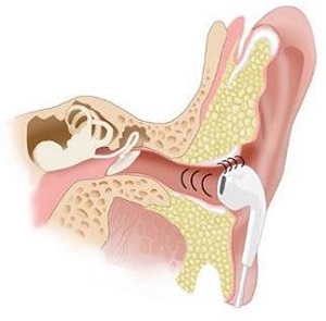 Non-custom earbuds allow low frequencies to enter and escape through gaps between the ear canal and the headphone