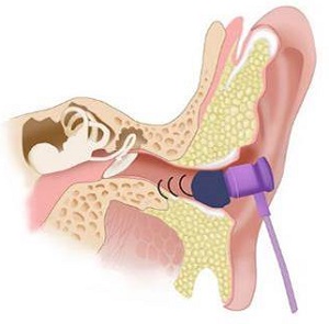 The high frequencies can be absorbed rather than bend around sharp bends in a curvy ear canal fit with a non-custom earbud