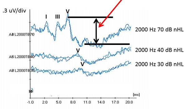 These waveforms illustrate an example in which a Clear Response was obtained at 30 dB nHL