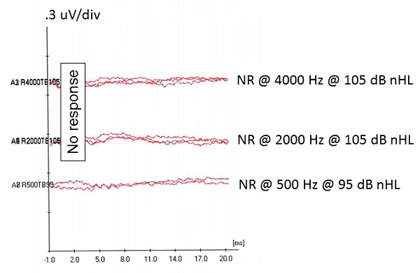 These waveforms illustrate an example in which a Response Absent was obtained