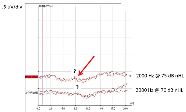These waveforms illustrate an example in which it is most appropriate for the audiologist to level the results as Inconclusive