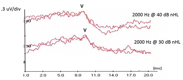 These waveforms illustrate an example in which the audiologist adhered to the NHSP gold standard to ensure that a response was present at 30 dB nHL