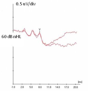 Robust response obtained at 60 dB nHL with waves III and V clearly identified