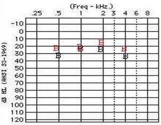Audiogram from a 4-year old female with Treacher Collins syndrome who uses Divino processors
