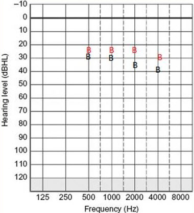 Audiogram from a 6-year old male with Treacher Collins syndrome who uses BP100 processors