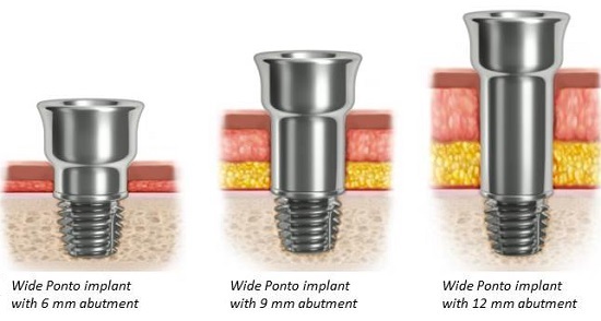 Various abutment choices for different skin tissue compositions