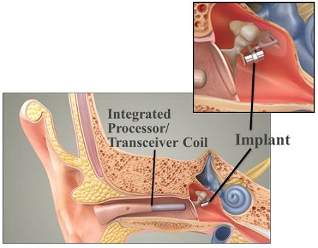 Maxum middle-ear implant