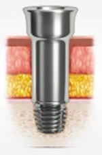 The Ponto abutment attached to implant
