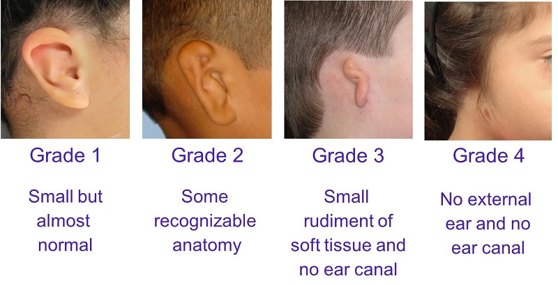 Microtia grading system