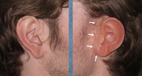 Prosthetic versus normal ear with indication of the connection to the skin