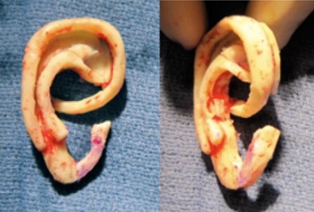 Final shape of the ear from the rib cartilage
