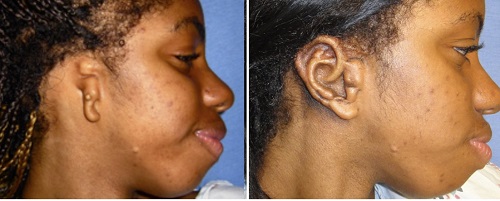 Before and after the first rib cartilage surgery