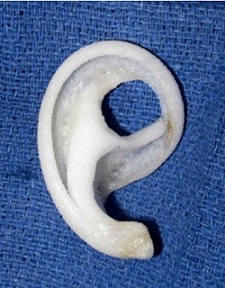 Medpor ear prosthetic