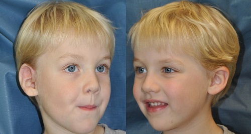 Low-set ears and pinna abnormalities Information