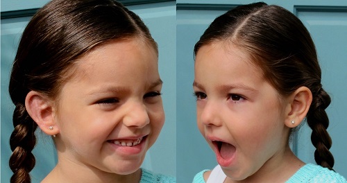 Three-year-old girl after surgery compared to unaffected ear