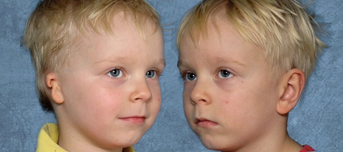 Grade 3 microtia patient before