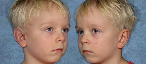 Grade 3 microtia patient after