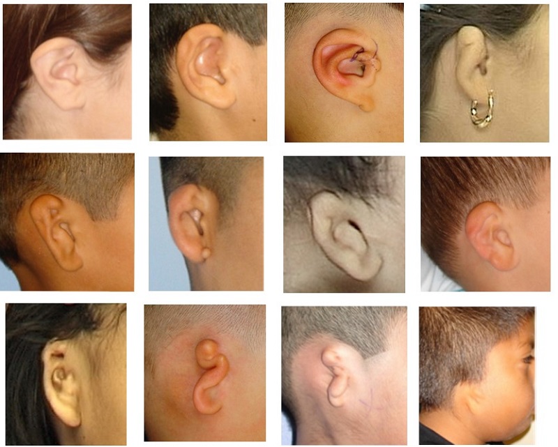 Microtia Ear Surgery And Bone Anchored Hearing Devices