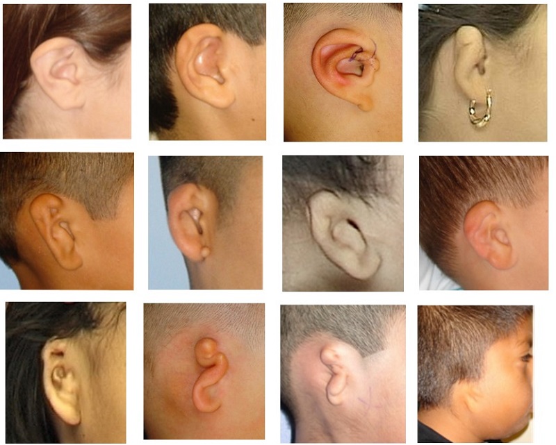 Progression of microtia severity