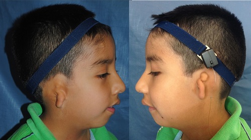 Bilateral microtia patient before