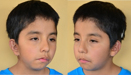 Bilateral microtia patient after