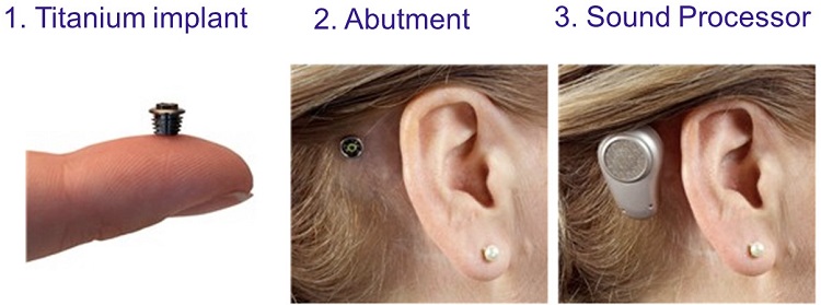 Three parts of a bone anchored system from Oticon Medical Ponto Plus