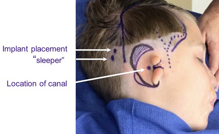 Combined Medpor surgery and bone anchored implants