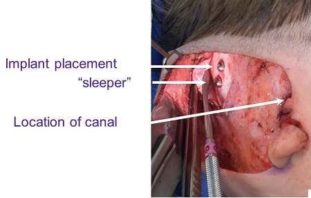 Surgical placement of implant and sleeper under soft tissue flap