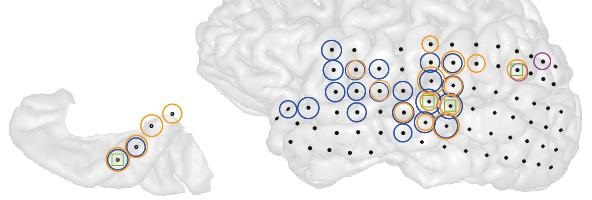 3-D image of the left brain hemisphere of a patient with tinnitus and the part of that hemisphere containing primary auditory cortex